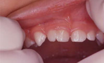 癒合歯の画像1