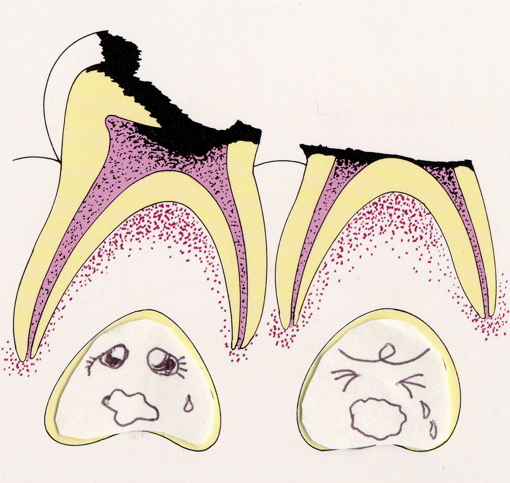 乳歯の虫歯の影響は エンゼル歯科 院長にっき