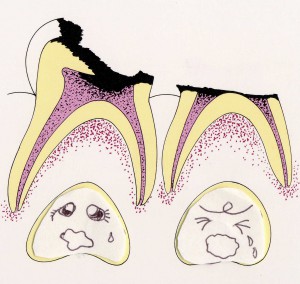 乳歯のむし歯の影響
