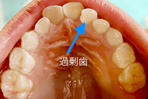 乳歯の過剰歯