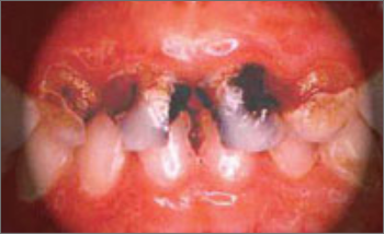 乳歯の前歯の重度の虫歯(むし歯)の治療前