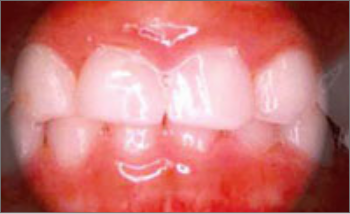 乳歯の前歯の重度の虫歯(むし歯)の治療後