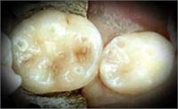 ちいさな虫歯(むし歯)の治療前