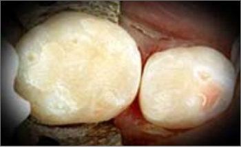 ちいさな虫歯(むし歯)の治療後
