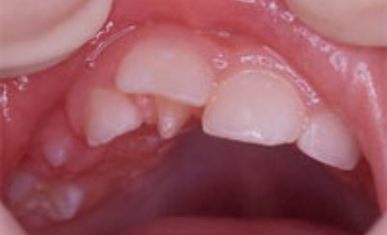 切歯結節の画像