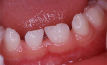 癒合歯の画像2