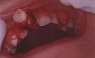 歯肉や小帯の外傷 治療前