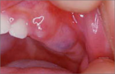 歯ぐきが紫色に腫れたようになっている。これは萌出のう胞(ほうしゅつのうほう)といいます。