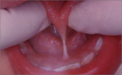 舌小帯についての画像