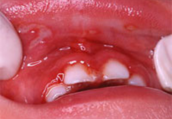 38～40度の高熱の後に、口の中を痛がる、歯肉出血、口臭などの症状の画像
