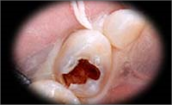 乳歯の奥歯の重度の虫歯(むし歯)の治療前